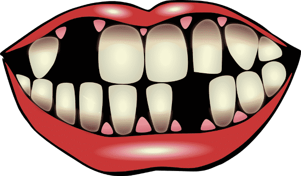 استبدال الأسنان المفقودة